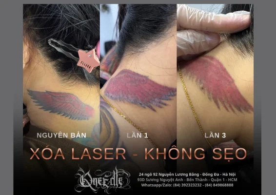 Tattoo removal effectiveness 1 – Qneedle Tattoo Hanoi