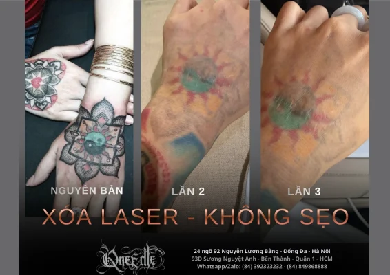 Tattoo removal effectiveness 1– Qneedle Tattoo HCM