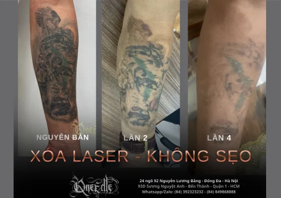 Tattoo removal effectiveness 2 – Qneedle Tattoo HCM
