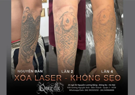 Tattoo removal effectiveness 2 – Qneedle Tattoo Hanoi