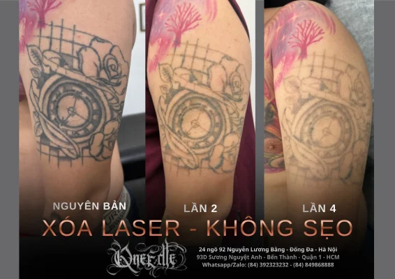 Tattoo removal effectiveness 3 – Qneedle Tattoo Hanoi