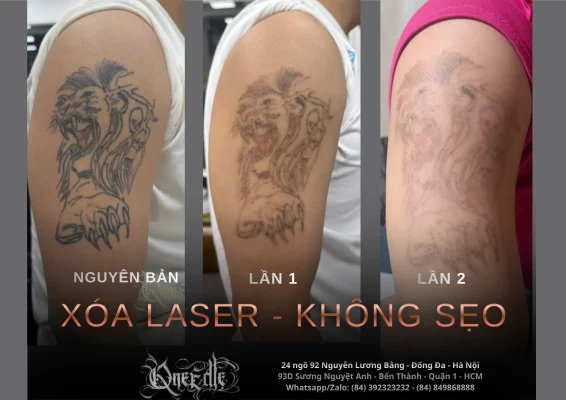 Tattoo removal effectiveness 3– Qneedle Tattoo HCM