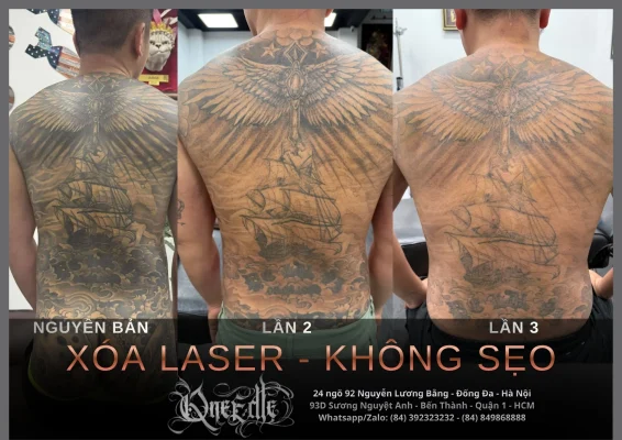Tattoo removal effectiveness 4 – Qneedle Tattoo Hanoi