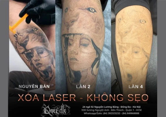 Tattoo removal effectiveness 4– Qneedle Tattoo HCM