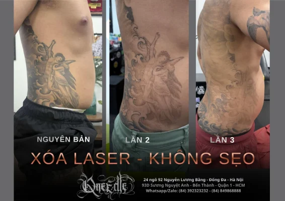 Tattoo removal effectiveness 5 – Qneedle Tattoo Hanoi