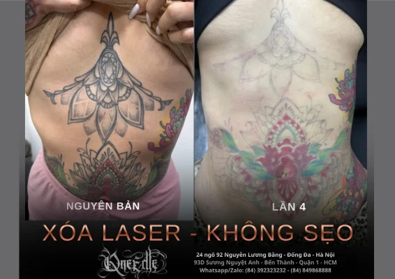 Tattoo removal effectiveness 5– Qneedle Tattoo HCM